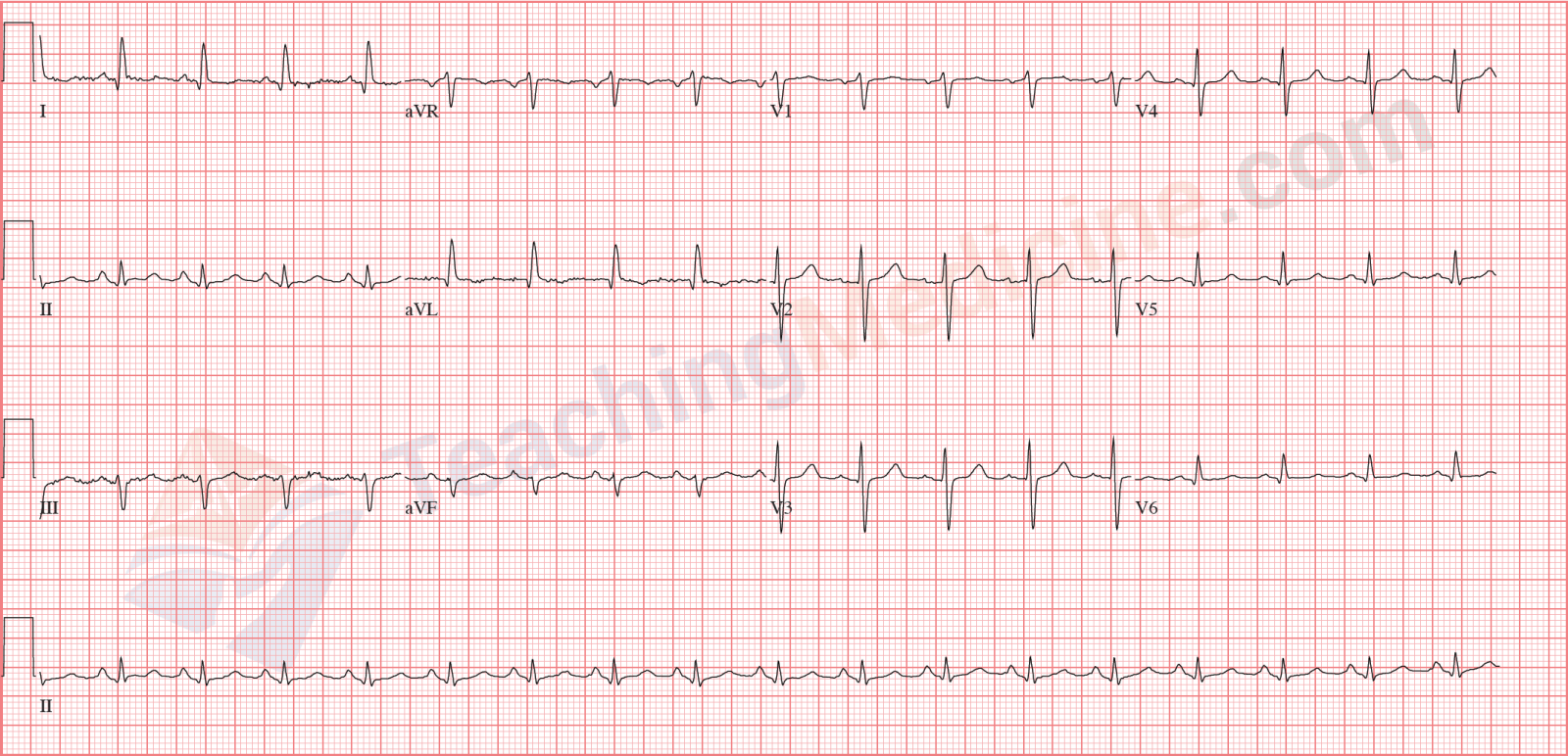 sinus-tachycardia